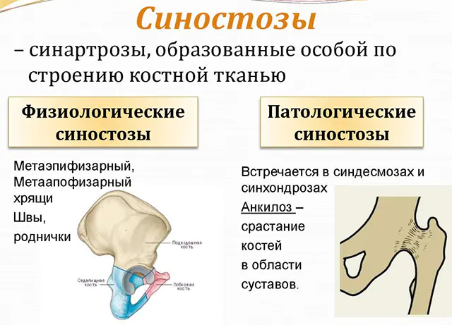 Sinostosis