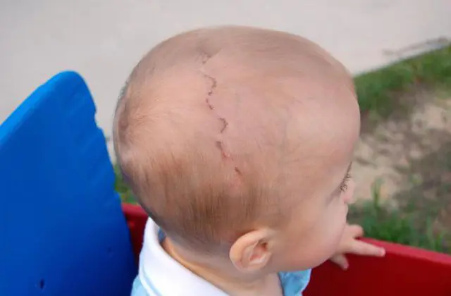 Bir çocuğun kafatasındaki kemiklerin sinostozu