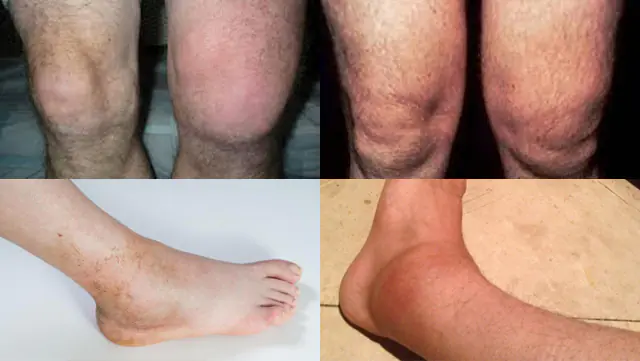 膝と足首の滑膜炎
