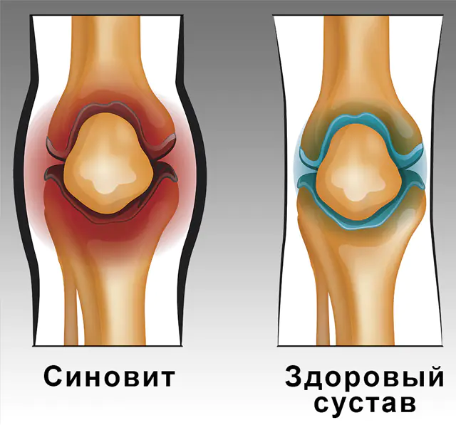 Sintomas de sinovite da articulação do joelho