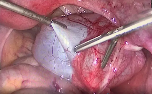 Abdominal adhesions – laparoscopic surgery