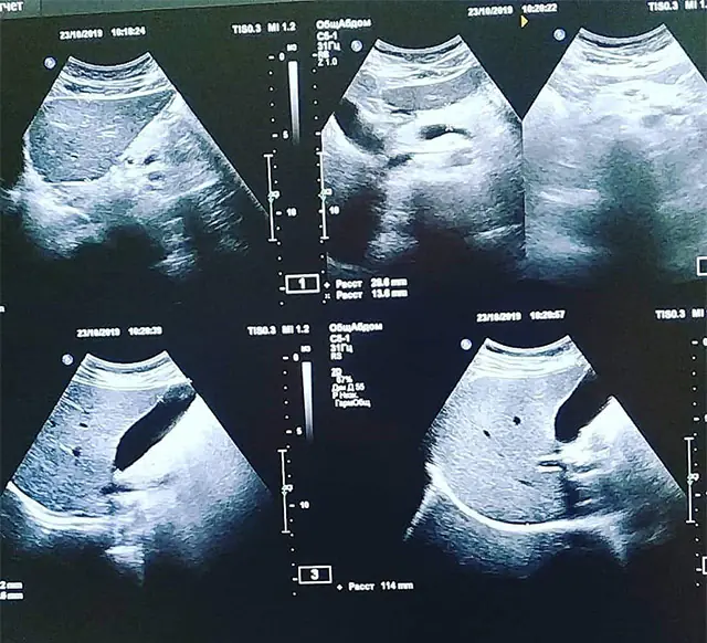 Diagnostic par ultrasons pour détecter la maladie adhésive