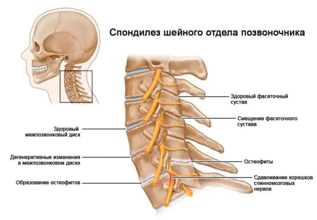 Schéma spondylózy