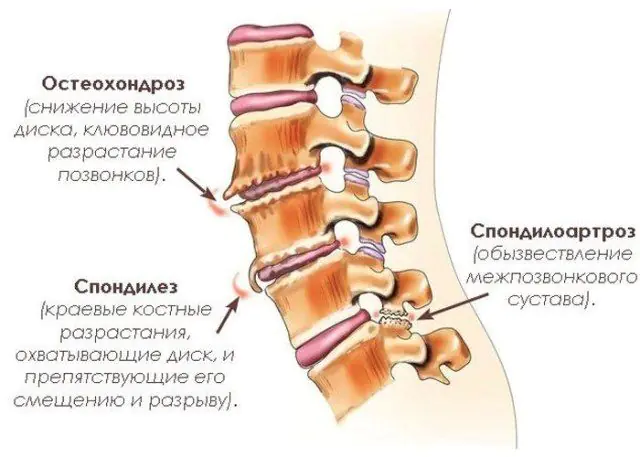 Patologiska processer i ryggraden