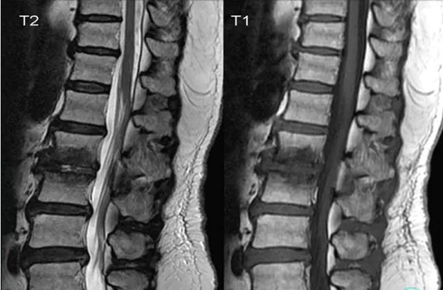 Rentgenový snímek obratle - příznaky spondylitidy