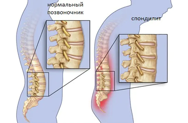 Spondylarthrite de la colonne vertébrale