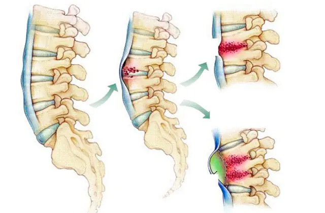Spondilite della colonna vertebrale