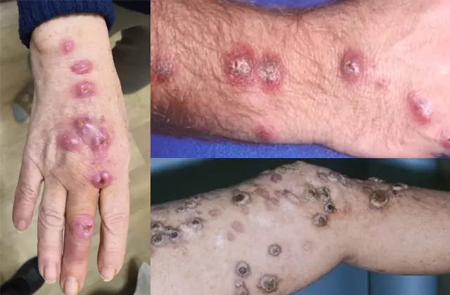 Sporotrichosis in humans on the arms and legs