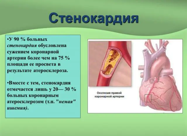 Causes of angina