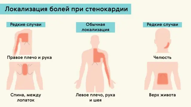 Localizzazione del dolore durante l'angina pectoris