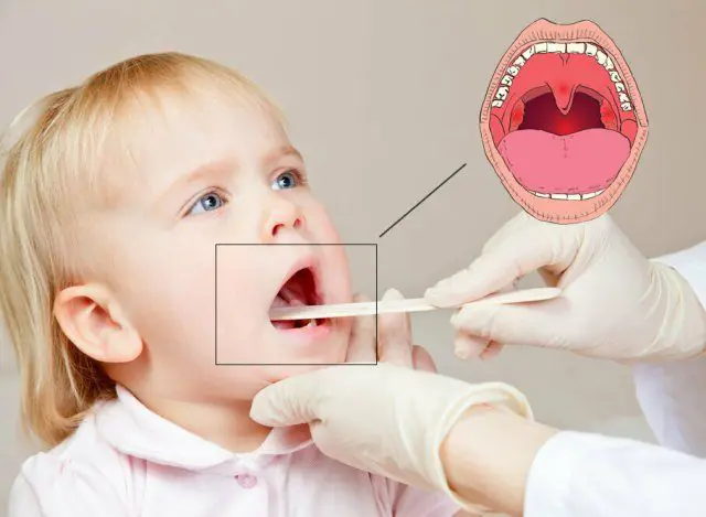 儿童口腔炎的诊断