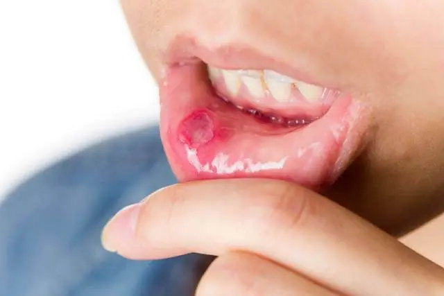 Zapalenie jamy ustnej u dzieci
