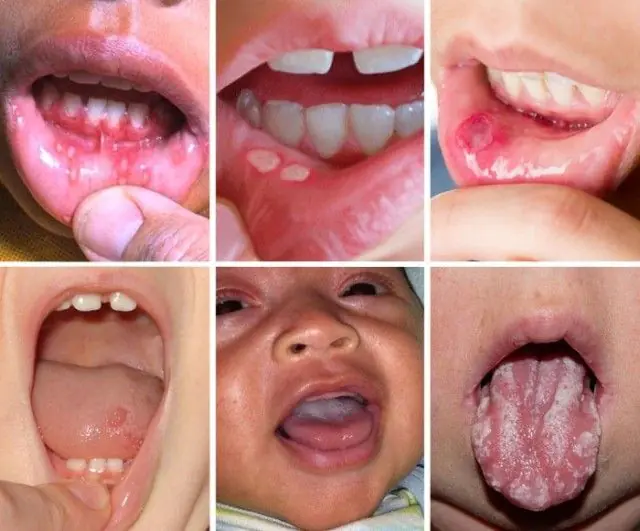 A szájgyulladás tünetei gyermekeknél