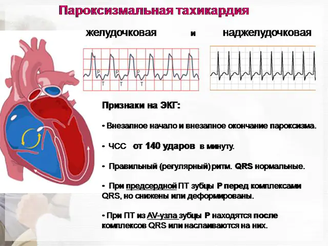 paroxysmal tachycardia