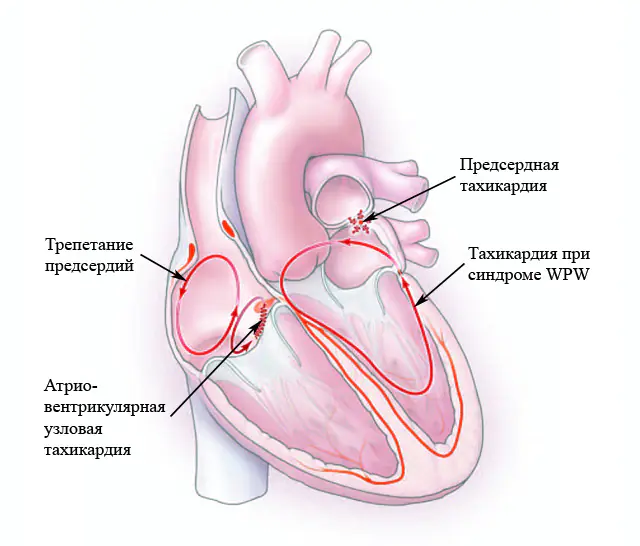 tachycardia during pregnancy