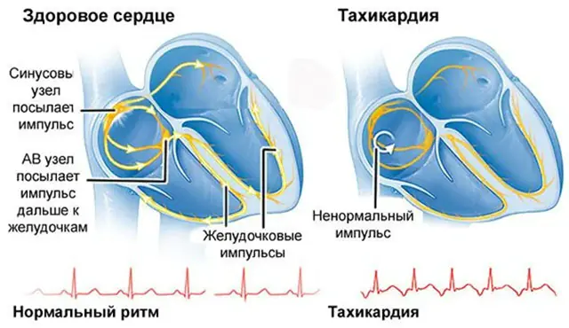 Mi az a tachycardia