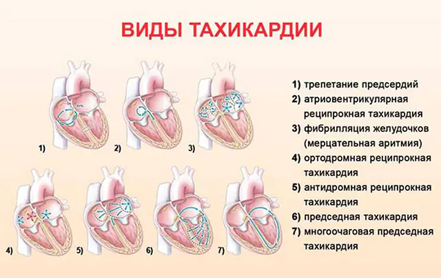 soorten tachycardie