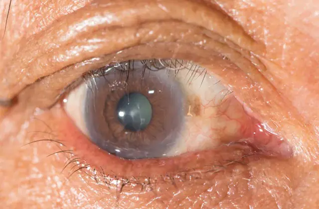 Trachoma eye disease