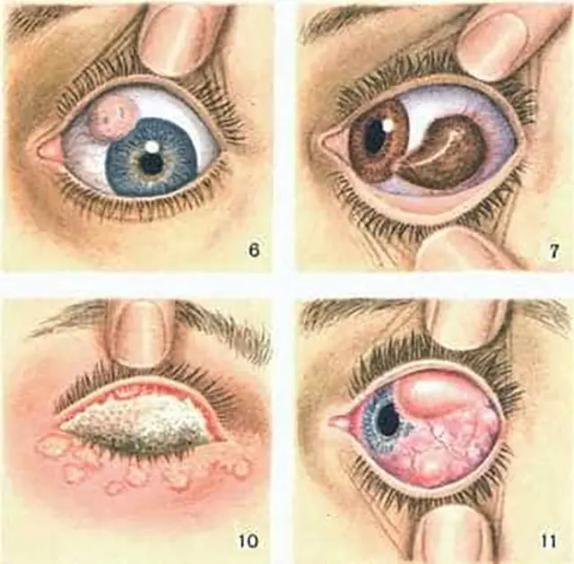Tracoma - malattia degli occhi