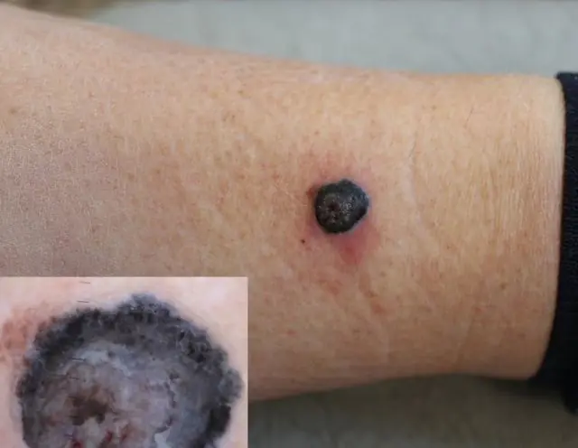 Ondartet tumor på stedet for en skadet papilloma