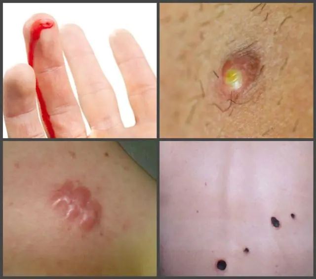 Consequences of laser papilloma removal