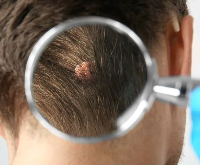 Papilloma op het hoofd in het haar