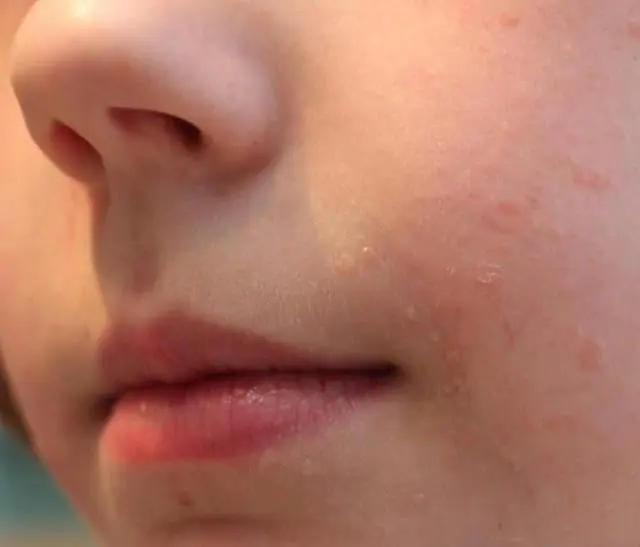 Verrugas planas no rosto de uma criança