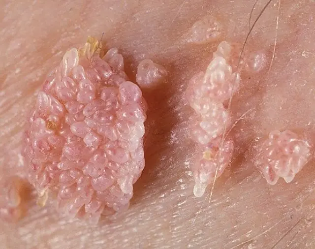 Genital warts in a child