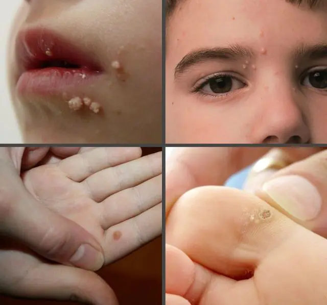 Localization of warts in a child