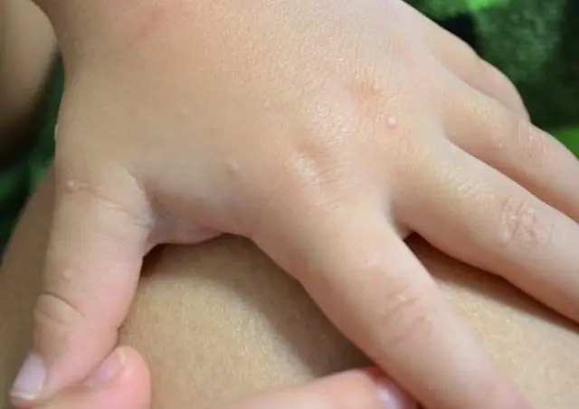 Simple warts in a child