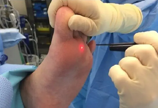 Laser removal of papilloma on the leg