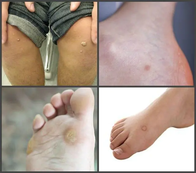 Papillomas on the legs