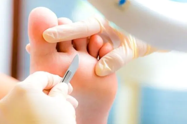 Removing papilloma on the foot with a scalpel