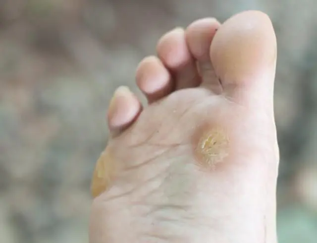 Papilloma on the foot