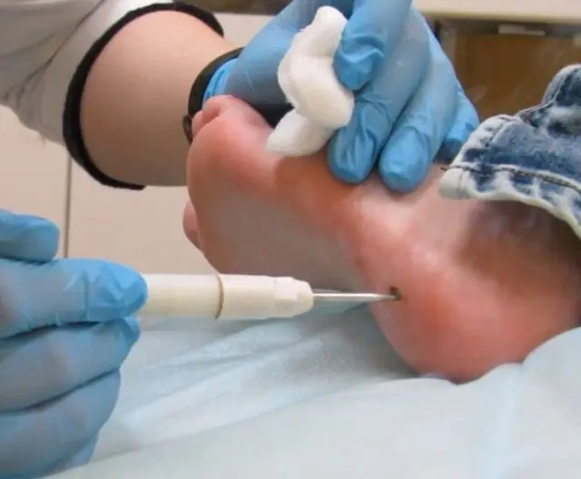 Removal of papilloma on the foot using electrocoagulation