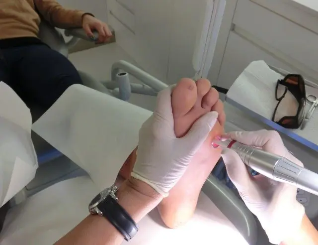 Laserverwijdering van papilloma op de voet