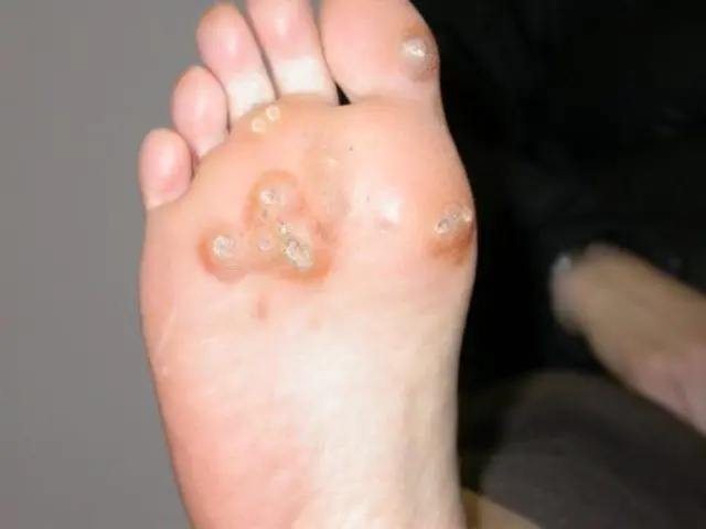 Papillomas on the foot