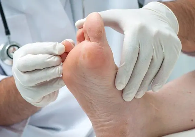 A doctor examines papillomas on the foot