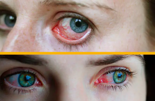 viral conjunctivitis in adults