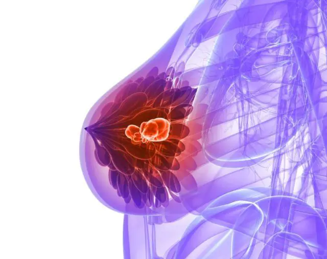 Esquema de papiloma intraductal de la glándula mamaria.