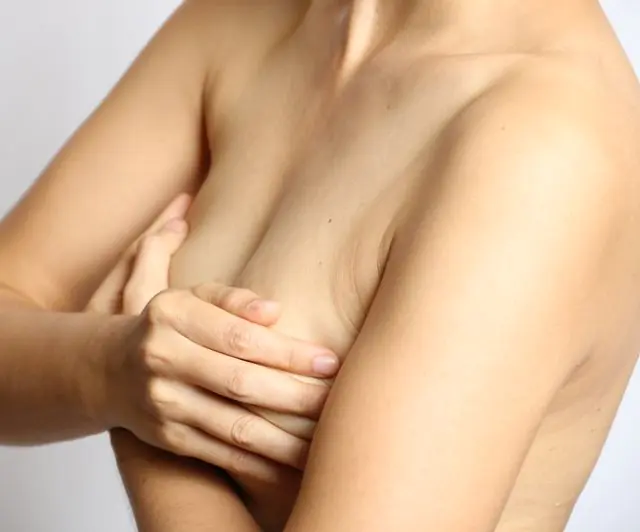 乳腺の乳管内乳頭腫