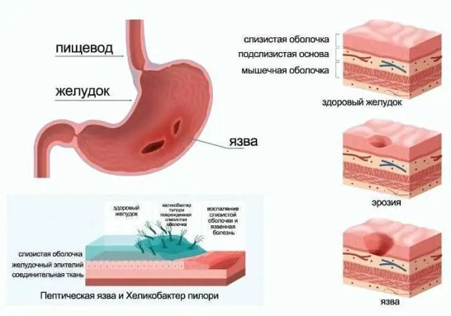 Gastritis ulcerosa y estómago sano