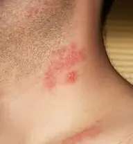 Bullous form of herpes zoster