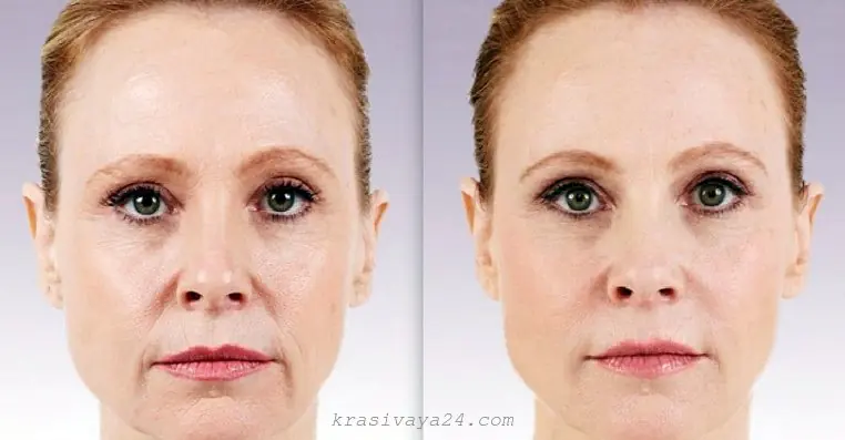 How to quickly remove nasolabial folds