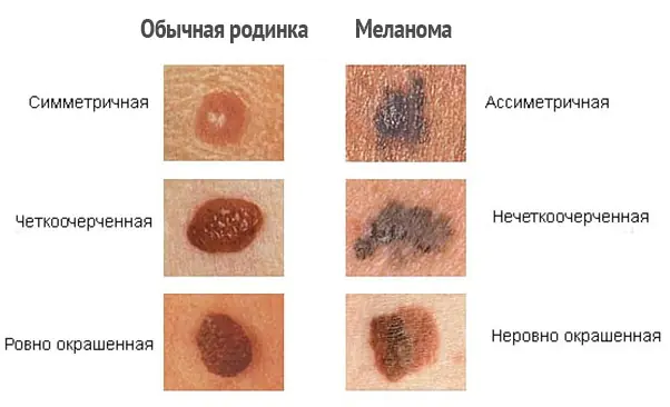 melanoma-bespigmentnaya-foto-qfugIH.webp