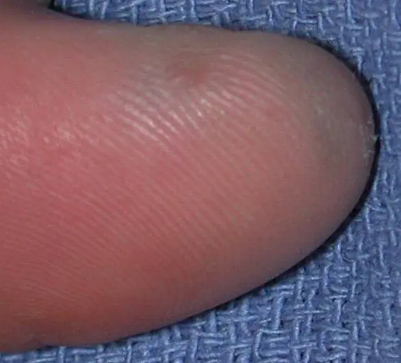 parmaklardaki melanom-el-fotoğraf-PmHro.webp