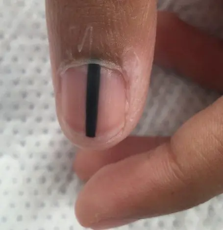 手指上的黑色素瘤照片-QpwYnn.webp