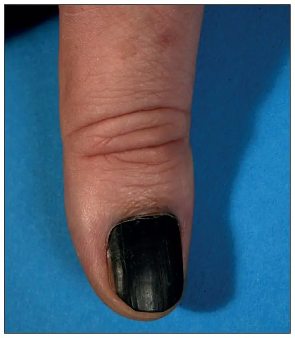 指の黒色腫-手-写真-WcszX.webp