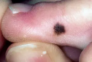 melanoma-di-ibu jari-ruki-foto-fhyaWcu.webp