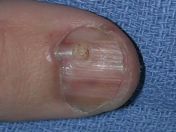 拇指上的黑色素瘤-照片-xpYql.webp